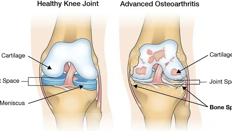 Degenerative osteoarthritis